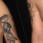 Transgender Breast Surgery