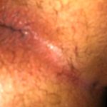 Anal Bleaching 101: Is It Dangerous To Bleach Your Butt Hole?